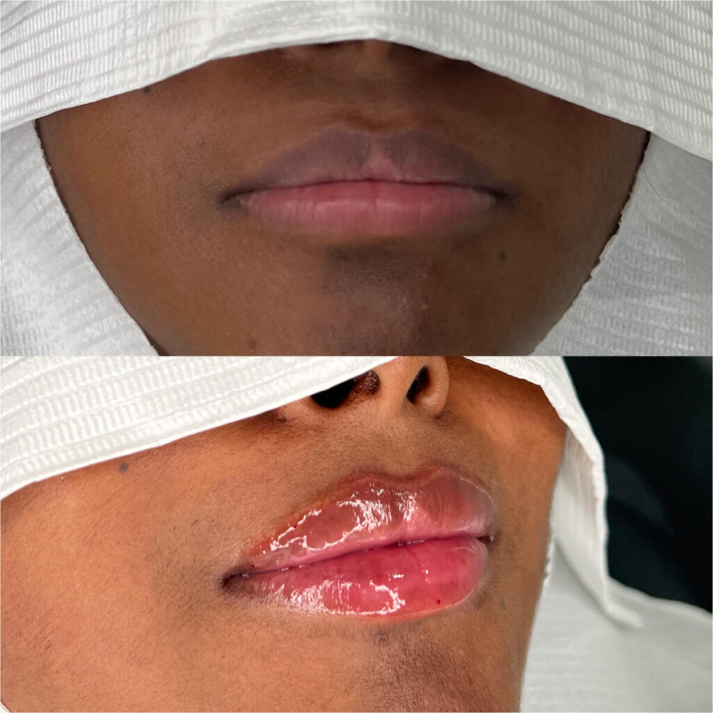 Lip Filler Treatment