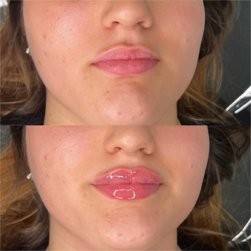 Lip filler Done at Facesbybae