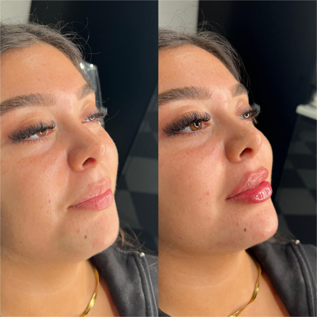 Lip Filler Treatment by Facesbybae