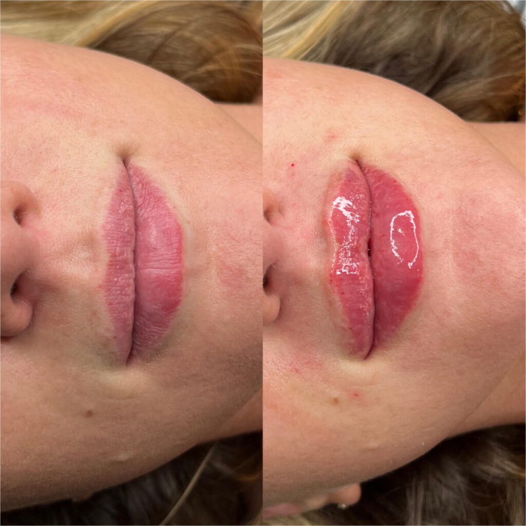 Lip Filler - Dental block treatment