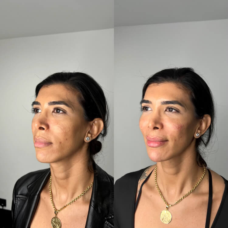 Cheek Filler Before/After