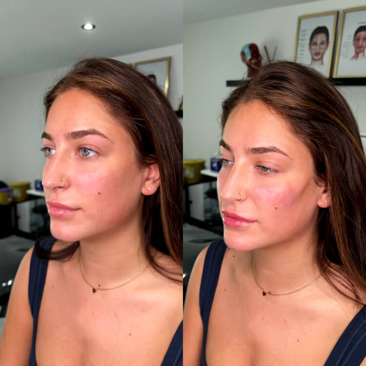 Before After Cheek Filler