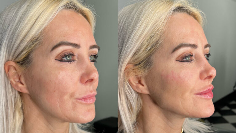 Derma Filler Package Treatment