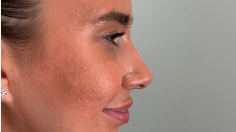 Droopy Nose Treatment at Facesbybae