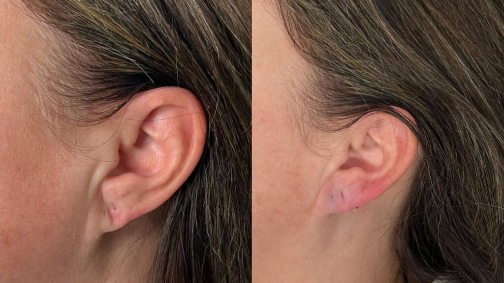 Earlobe Filler at Facesbybae