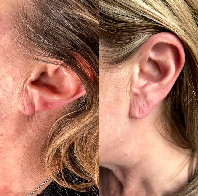 Ear Lobe Filler Treatment at Faces By Bae