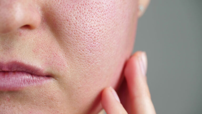 enlarged-pores