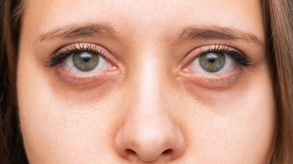 Hooded Eyes Condition