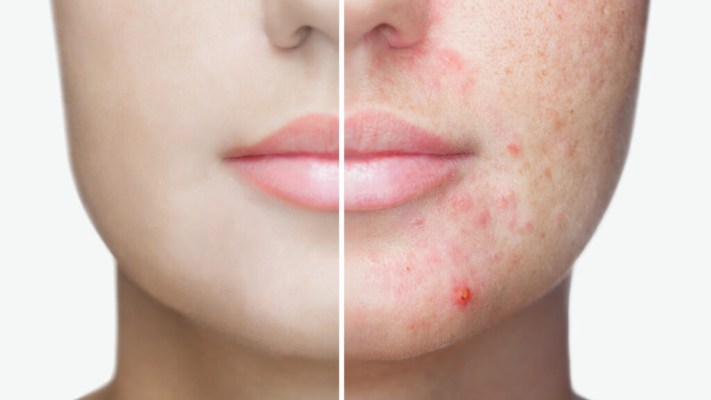 Laser Acne Removal Treatment at Facesbybae