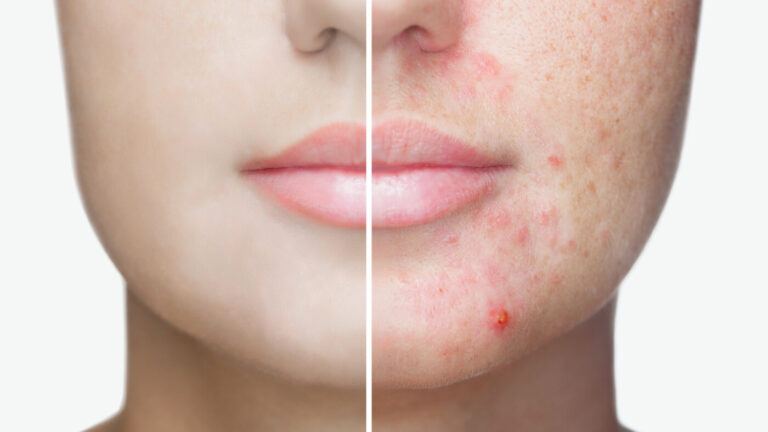 Laser Acne Removal Treatment at Facesbybae