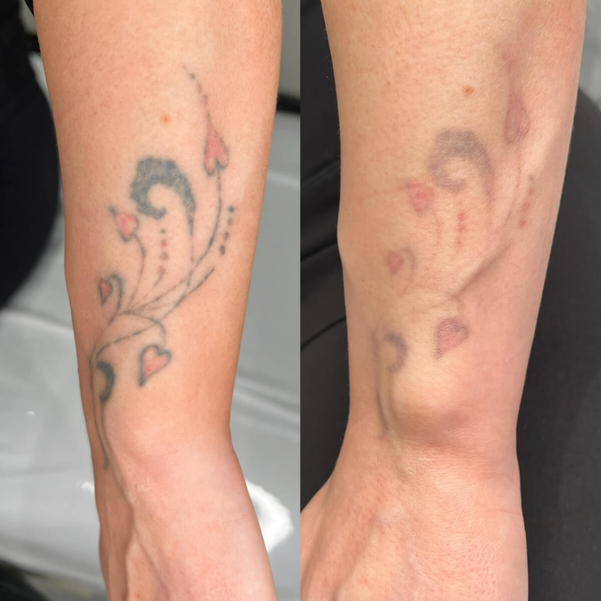 laser-tatto-removal-2