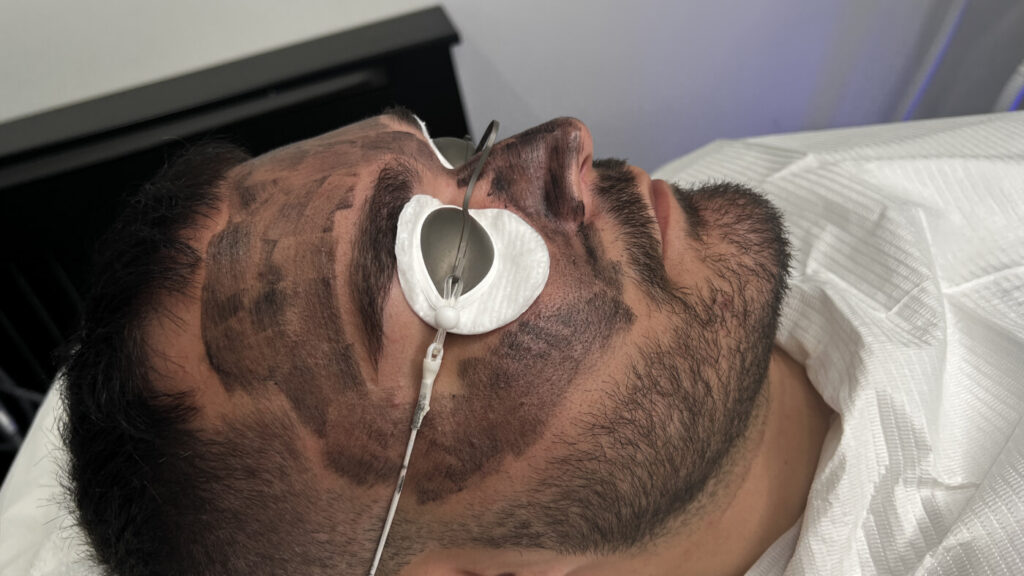 Laser Carbon Facial Treatment at Facesbybae