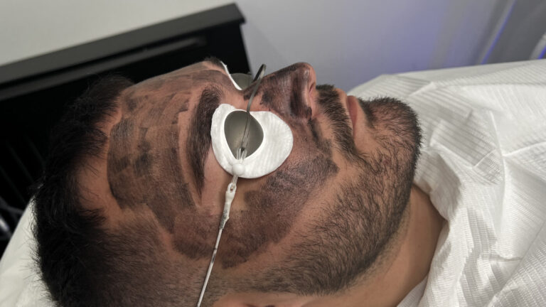 Laser Carbon Facial Treatment at Facesbybae