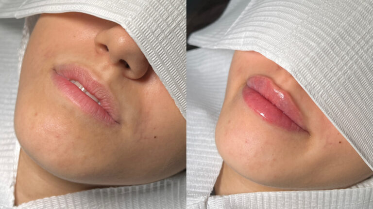 Lip Filler Treatment