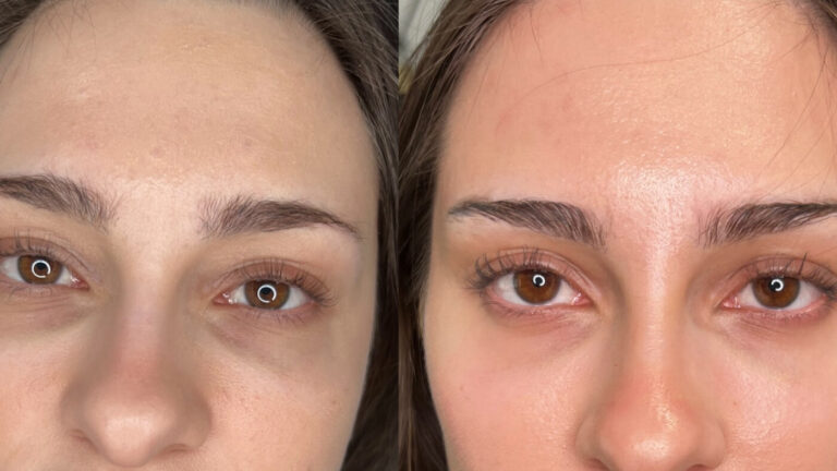 Lumi Eyes Treatment at Faces By Bae