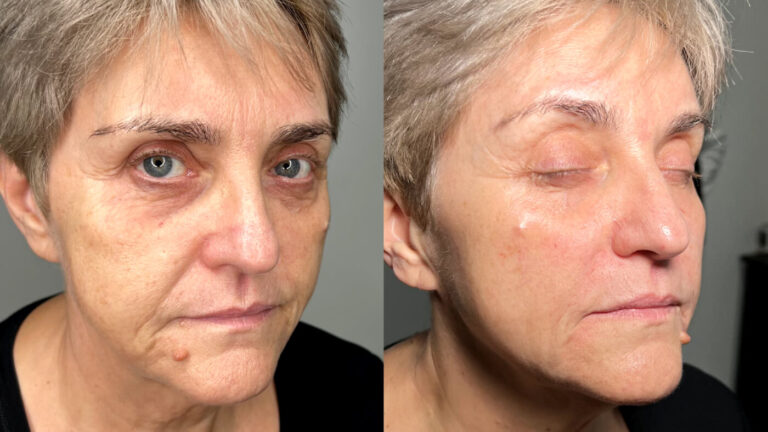 Marionette Lines Treatment at Faces By Bae