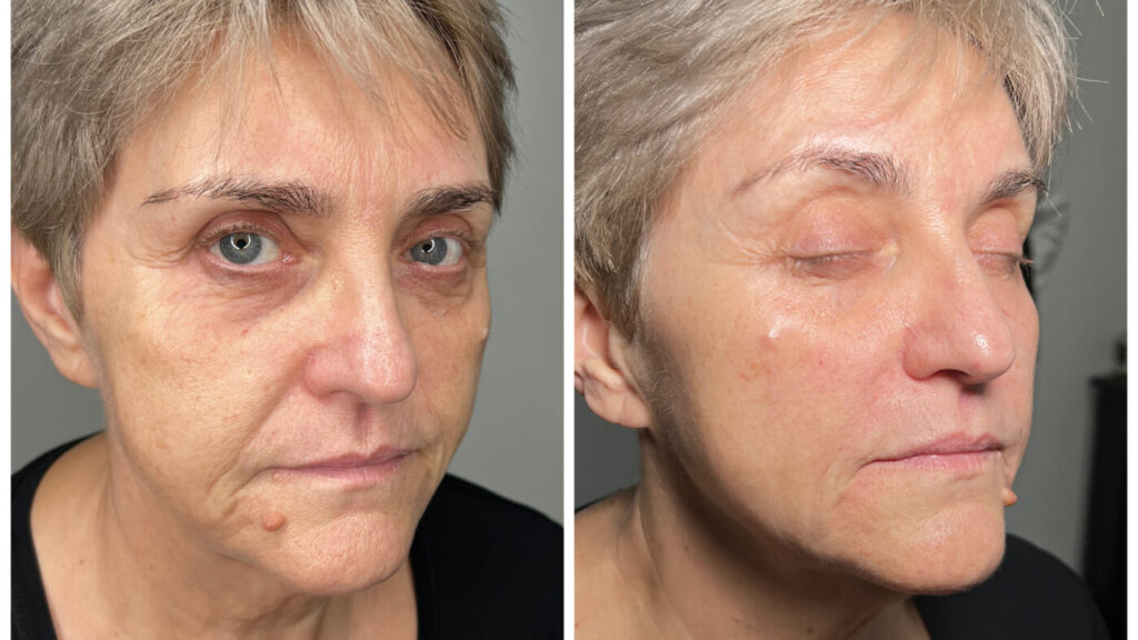 Marionette Lines Treatment at Facesbybae