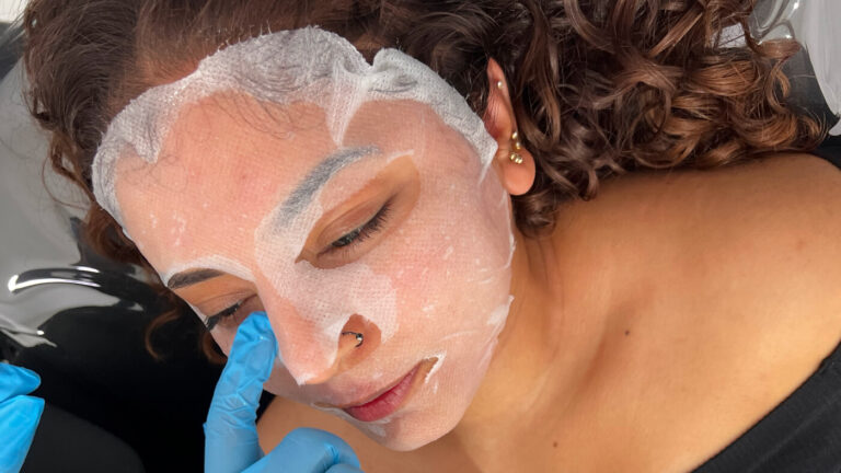 Microneedling Treatment