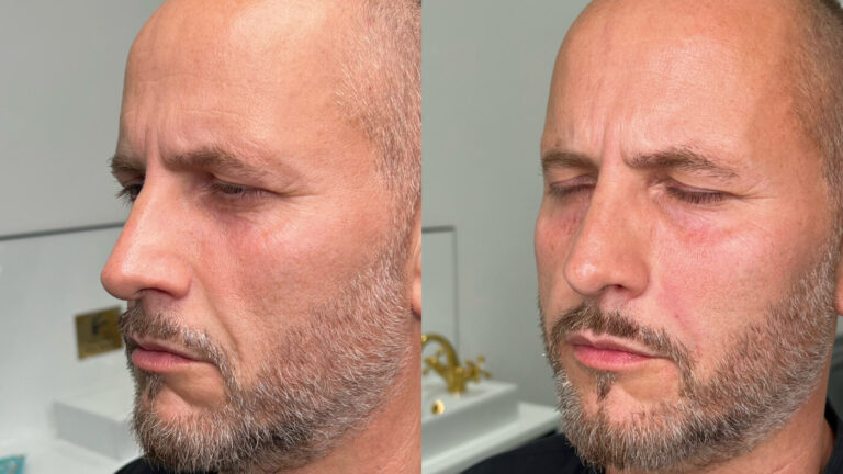 Nasolabial Folds Treatment