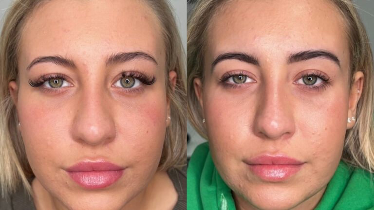 nostril-flare-reduction