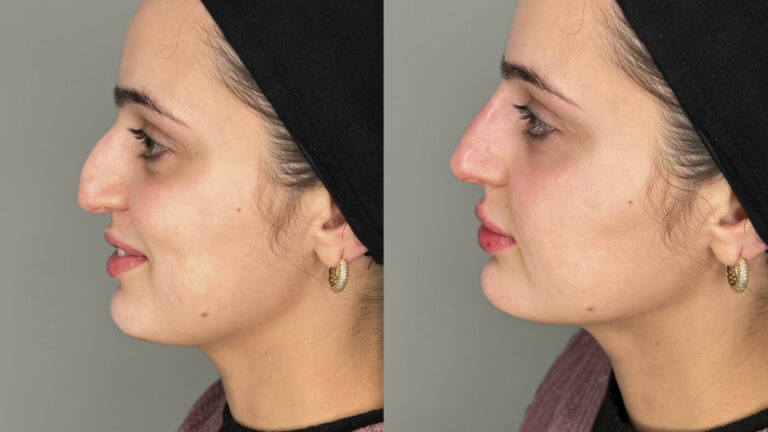 Non-surgical Rhinoplasty Treatment