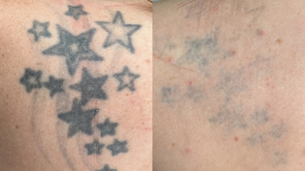 Tattoo Removal