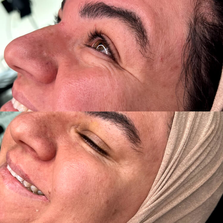 Under Eye Anti Wrinkle - Before After