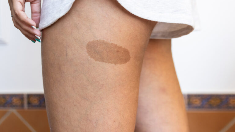 Laser Birthmark Removal Treatment at Facesbybae