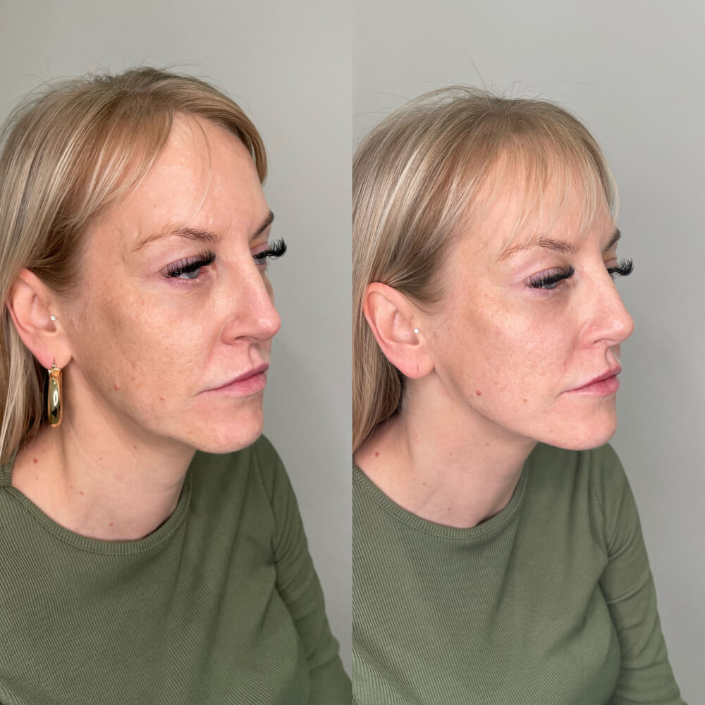 Jaw Filler Before After 6