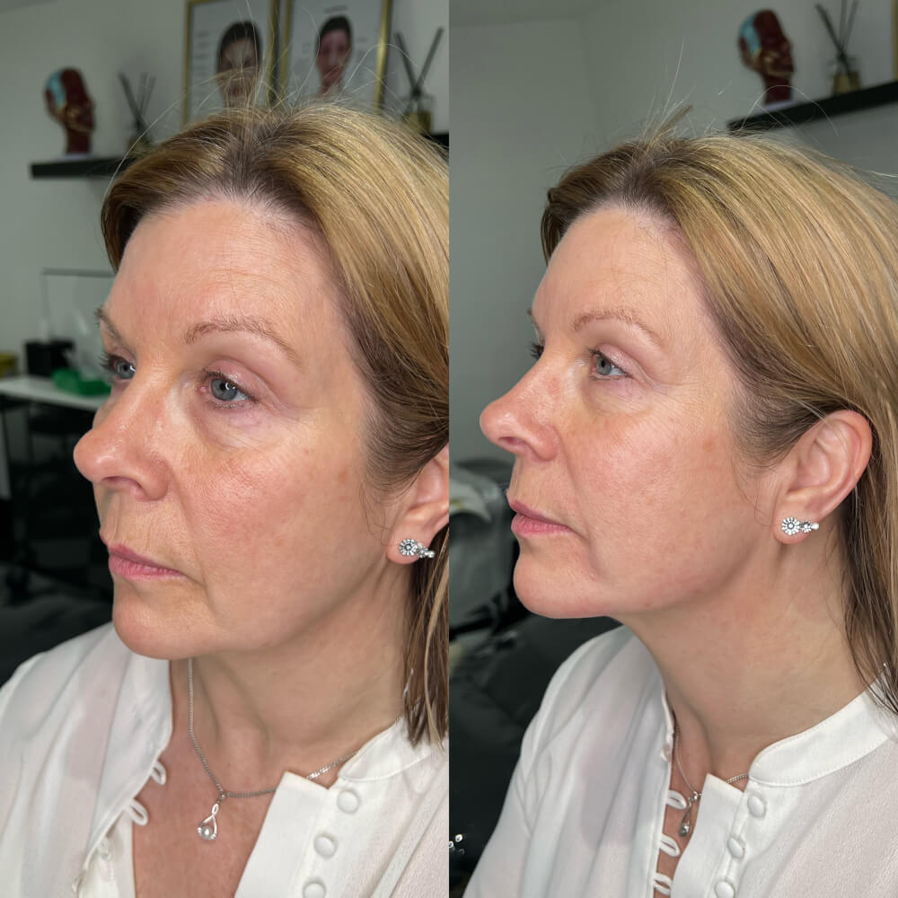 Jaw Filler Before After 5