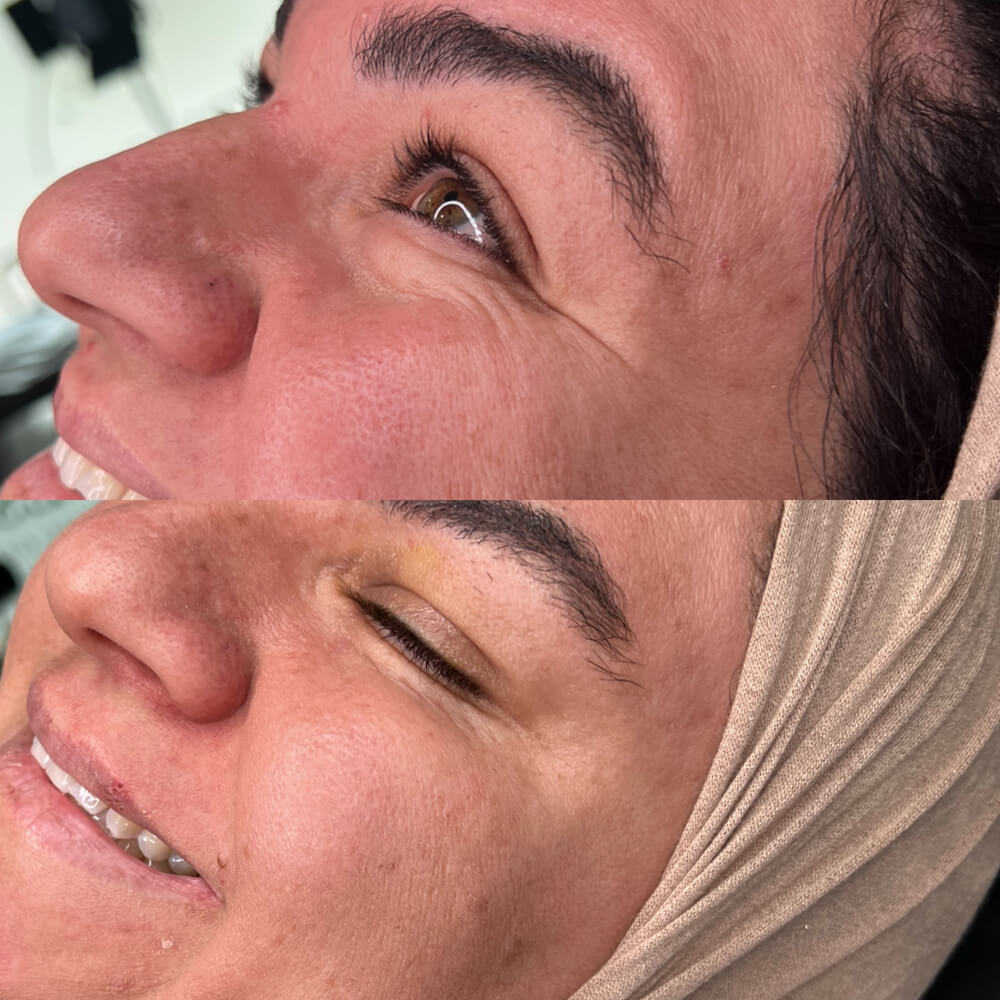 Crows Feet Before After at Faces By Bae