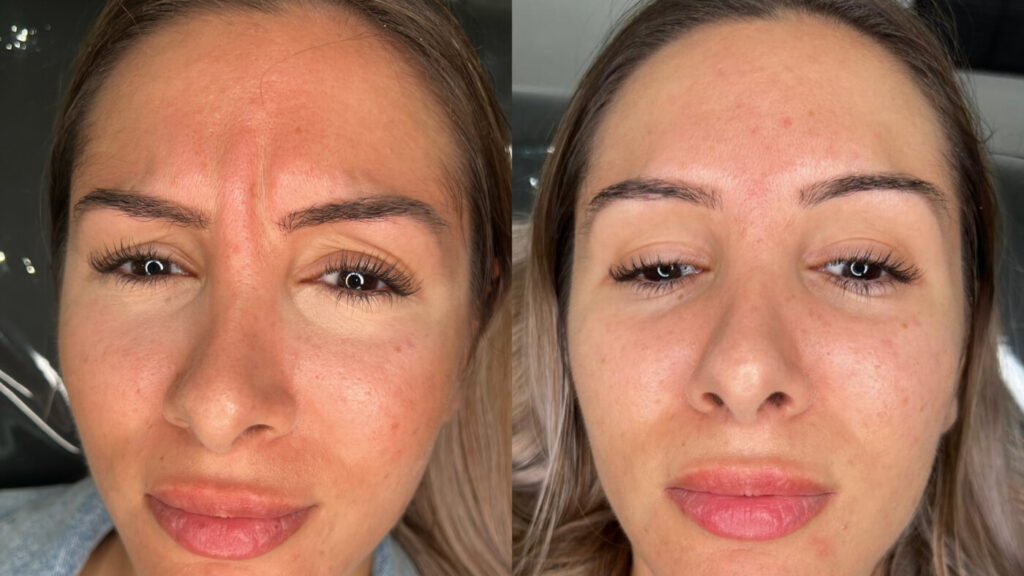 Frown Lines Treatment at Faces By Bae