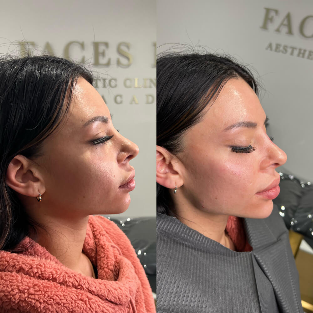 Jaw Filler Before After 3