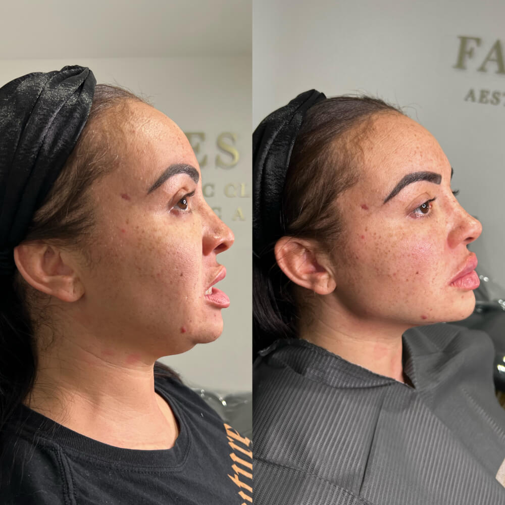 Jaw Filler Before After 2