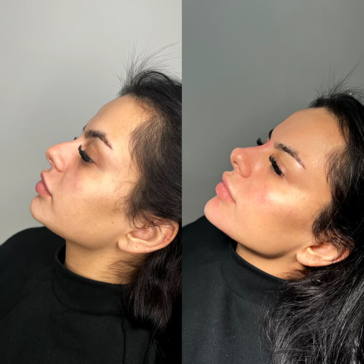 Jaw Filler Before After 3