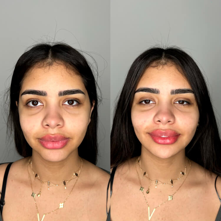 Jaw Filler Before After 2