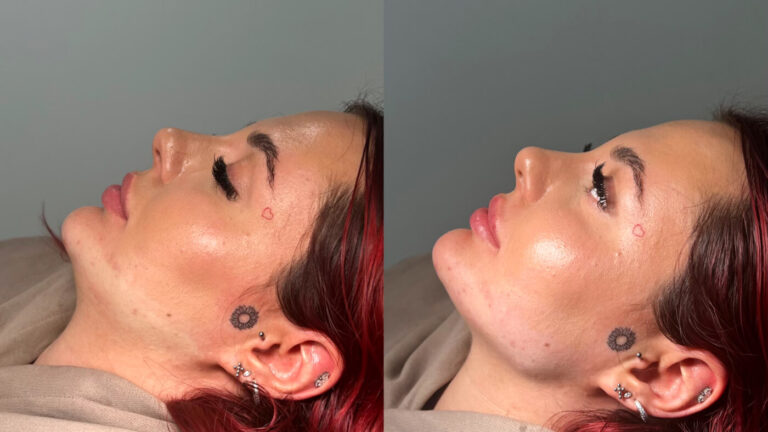 Jaw Filler Treatment at Faces By Bae