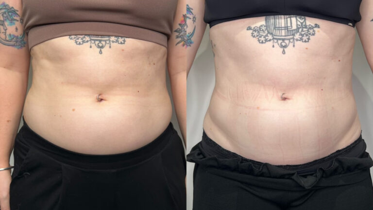 Laser Lipo Treatment at Faces By Bae