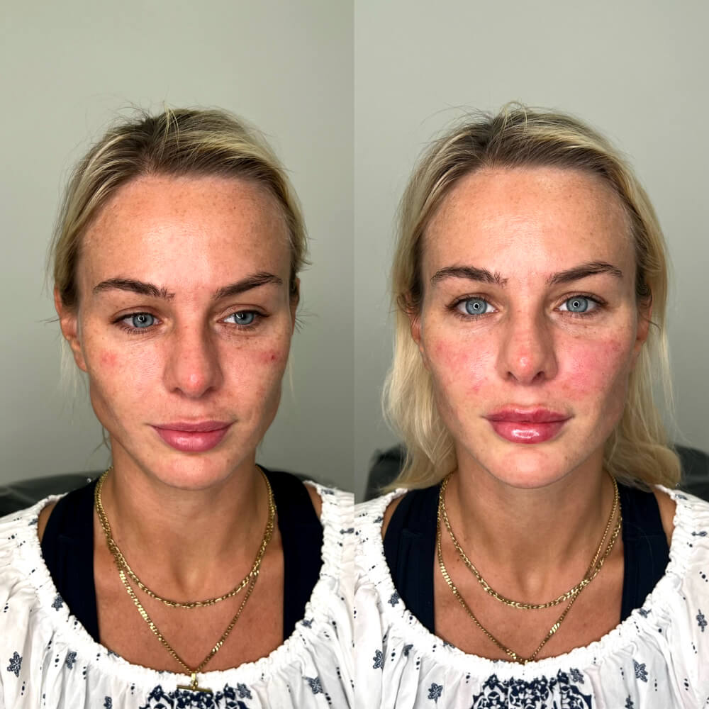 Mid Face Lift Filler - Before/After