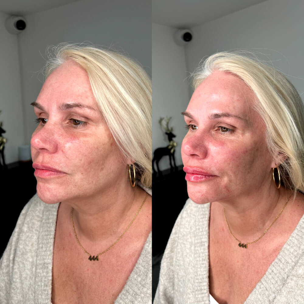 Mid Face Lift Filler - Treatment Before/After