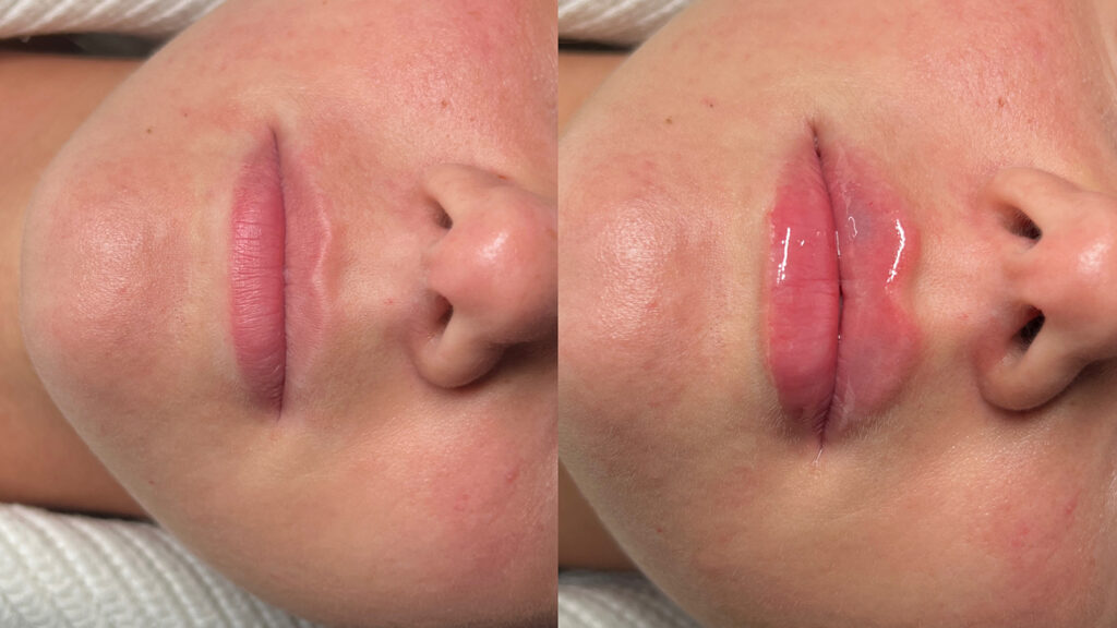 The Difference Between Lip Filler vs Lip Flip