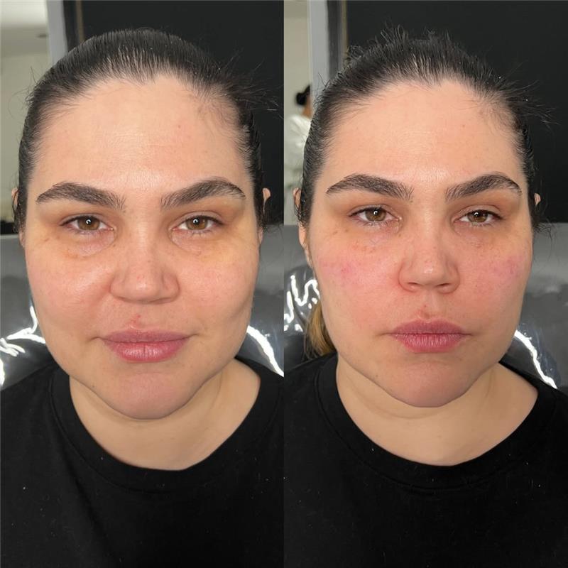 before and after skin treatment