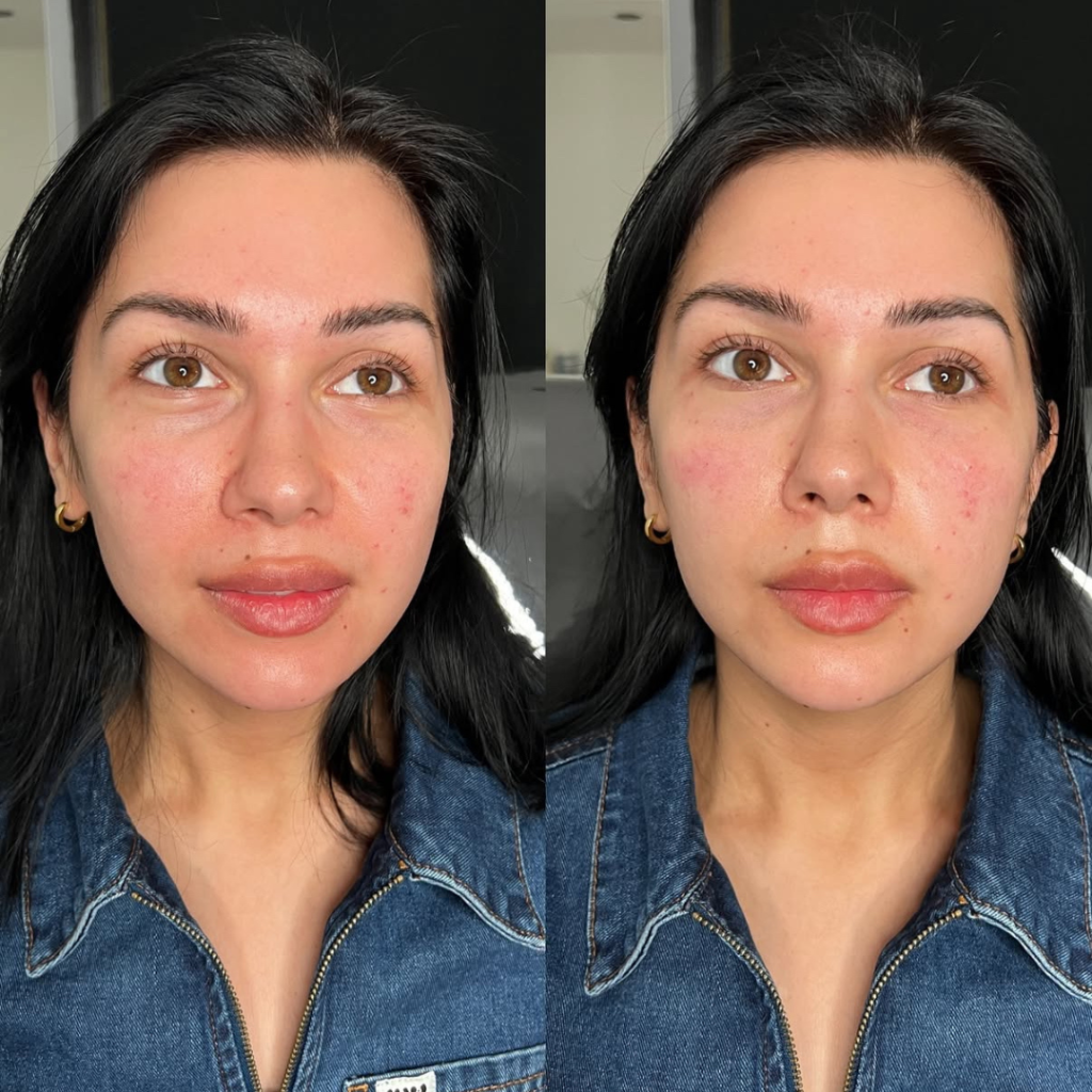 before and after skin treatment