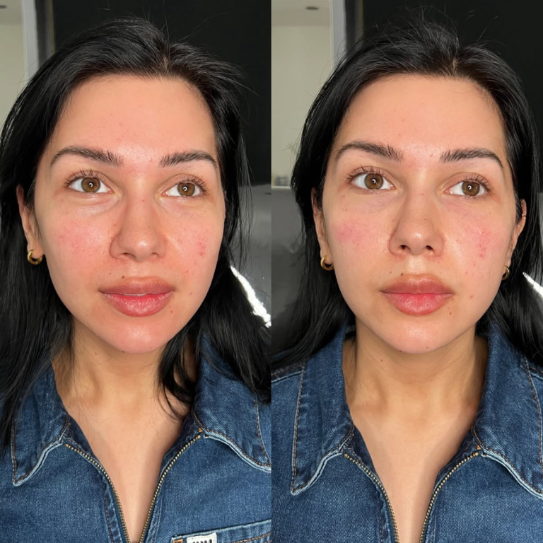 before and after skin treatment