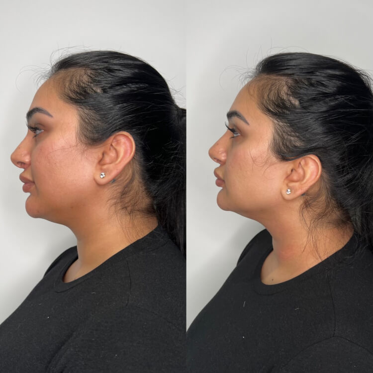 Understanding Laser Lipo: The Process & Aftercare